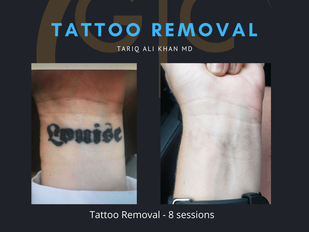 Gentle Care Laser Tustin Before and After picture - Tattoo Removal